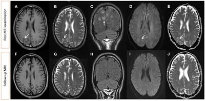 Case report: Reversible encephalopathy caused by dyskinesia-hyperpyrexia syndrome